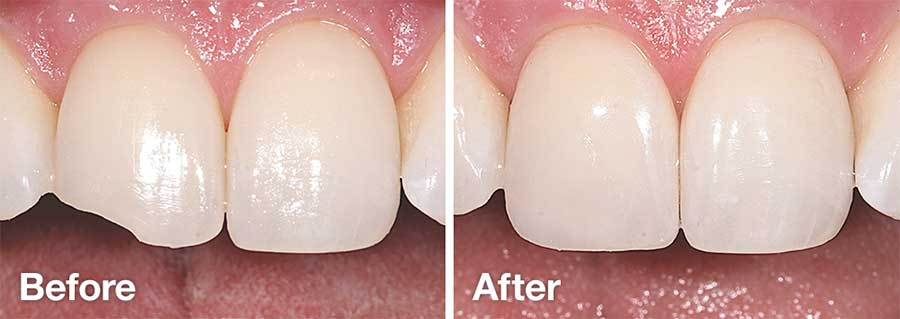Before & after of composite bonding